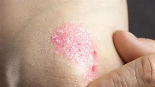 Ψωρίαση κατά πλάκας: Ενοχλητικά συμπτώματα και συννοσηρότητες