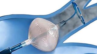 Η πρώτη διεγχειρητική κατάλυση πνευμονικών φλεβών με χρήση Cryoballoon στην Ελλάδα