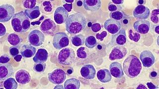 Πολλαπλούν μυέλωμα και ψυχική υγεία