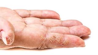 Η σεκουκινουμάμπη  στην ψωρίαση των ονύχων, παλαμών και πελμάτων