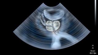 Καρκίνος του προστάτη: Σχετίζεται με σεξουαλικά μεταδιδόμενη νόσο;