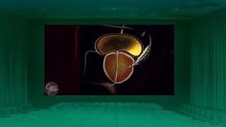 Καρκίνος του προστάτη: Τι πρέπει να γνωρίζουμε για την αντιμετώπισή του