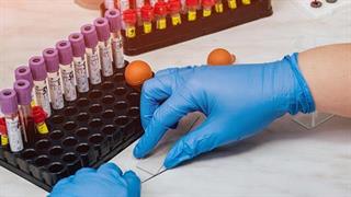 Εξέταση αίματος εντοπίζει τη νόσο Alzheimer χρόνια πριν την εκδήλωση συμπτωμάτων