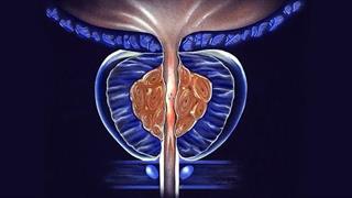 Χωρίς έγκριση από τον ΕΟΦ το προϊόν Prostalgene