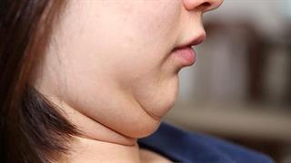 Πώς θα χάσω λίπος από το πρόσωπο;