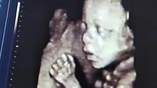 Τετραδιάστατη απεικόνιση του εμβρύου στη μήτρα