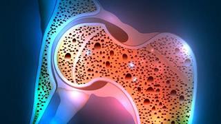 Οστεοπόρωση: τα προβιοτικά επιβραδύνουν την οστική απώλεια