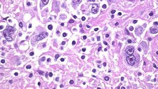 Αποτελεσματικός ο συνδυασμός Ibrutinib με Rituximab 