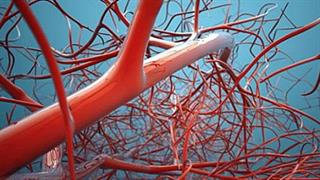 TAXINOMISIS: ευρωπαϊκό πρόγραμμα με τη συμμετοχή του ΕΚΠΑ σχετικά με την καρωτιδική νόσο