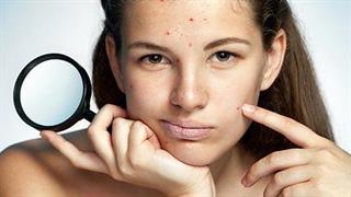 Σημάδια ακμής: 5 τρόποι φυσικής αντιμετώπισης