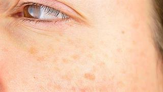 Πανάδες μετά τις διακοπές: Υπάρχει μόνιμη θεραπεία;