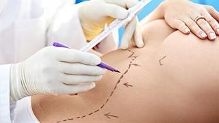 Κοιλιοπλαστική: Όσα πρέπει να ξέρετε