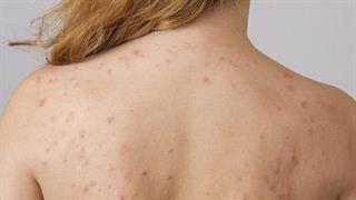 Πώς να απαλλαγείτε από την ακμή στην πλάτη και στους ώμους