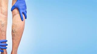 Οι ψηλοί κινδυνεύουν περισσότερο από την εμφάνιση κιρσών