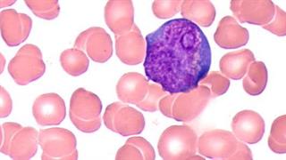 Λευχαιμία: Τα νεότερα δεδομένα