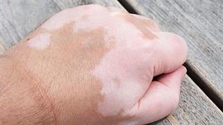 Πέντε φορές θα αυξηθεί ο τζίρος στα ορφανά φάρμακα για δερματικές παθήσεις