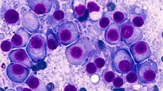 Το Daratumumab ως θεραπεία πρώτης γραμμής για τους ασθενείς με  Πολλαπλούν Μυέλωμα