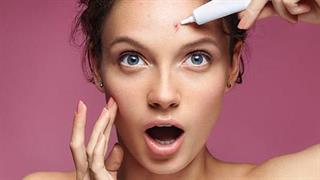 Τι σημαίνει να έχετε ορμονική ακμή;