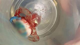 Αντιμετωπίστηκε με επιτυχία μωρό που κατάπιε την πιπίλα του