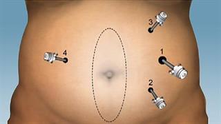 Πρωτοποριακή επέμβαση κοιλιοκήλης στο Metropolitan Hospital   