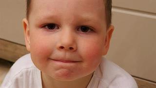 Πώς θα φροντίσω την ατοπική δερματίτιδα στο παιδί μου;