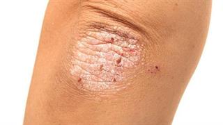 Αποτελέσματα μελέτης για την απρεμιλάστη στην ψωρίαση