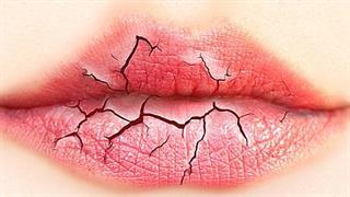 Τι προκαλεί η ξηροστομία;