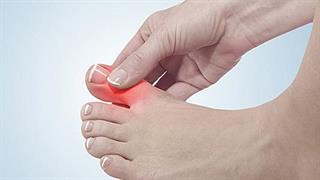 Η ουρική αρθρίτδα αυξάνει τον κίνδυνο χρόνιας νεφρικής νόσου