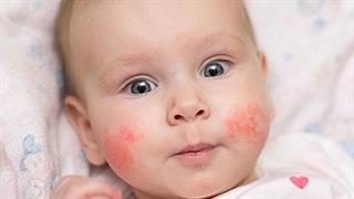 Πώς αντιμετωπίζεται η ατοπική δερματίτιδα