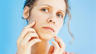 Πανάδες: Πώς θα εξαφανίσετε τις δυσχρωμίες από τον ήλιο