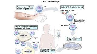 CAR-T λεμφοκύτταρα για την αντιμετώπιση ανθεκτικής μορφής λεμφώματος