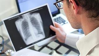 Σημαντική αύξηση των περιστατικών φυματίωσης έως το 2025 λόγω lockdown