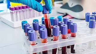 Abbott: Διαθέσιμα στην Ελλάδα εργαστηριακά τεστ ανίχνευσης αντισωμάτων COVID-19 στην Ελλάδα