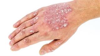 Φλυκταινώδης ψωρίαση: Ποια είναι τα είδη της