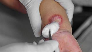 Πρώτες βοήθειες για την αντιμετώπιση των εγκαυμάτων