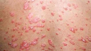 Η Σταγονοειδής ψωρίαση είναι σπάνια μορφή της νόσου