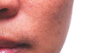 Μέλασμα: Πώς να προστατεύσετε το δέρμα σας από τις πανάδες