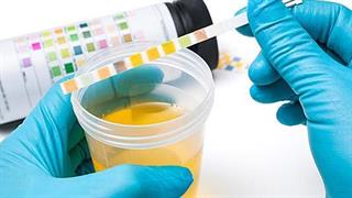 Μόρια στα ούρα δείχνουν την εξέλιξη του μελανώματος