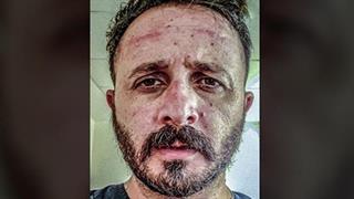 Ακτινολόγος ΠΑΓΝΗ προς αρνητές της μάσκας: "Εμείς παρακαλάμε να την έχουμε"...