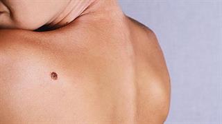 Χαρτογράφηση σπίλων: Γιατί πρέπει να γίνεται το φθινόπωρο;