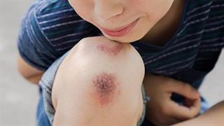 Προκαταρκτικά αποτελέσματα της μελέτης TOOL για την αιμορροφιλία