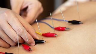 Ηλεκτροβελονισμός: μικρή επίδραση στον πόνο της πλάτης