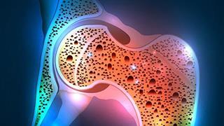 Οστεοπόρωση: Πότε μια επέμβαση μπορεί να αναδομήσει τα οστά;