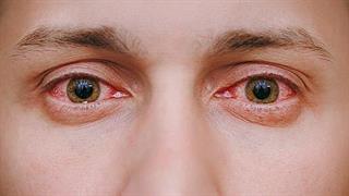 Ο κίνδυνος όσων πάσχουν από το πρωτοπαθές σύνδρομο Sjongren’s 