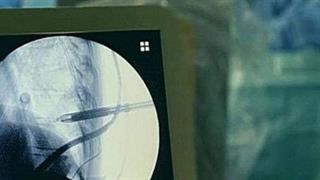 Για πρώτη φορά απόλυτα επιτυχημένη διαδερμική ενδοσκοπική δισκεκτομή