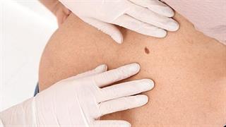 Ετήσιο δερματολογικό check-up: Πότε είναι αναγκαίο;