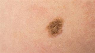 “Ελιές” της γήρανσης - Πόσο επηρεάζουν την ψυχολογία μας;