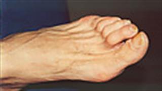 33 εκατομμύρια διαβητικοί στην Ευρώπη