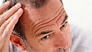 Ένας στους δύο άνδρες χάνει μαλλιά!