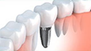 Τα υγιή δόντια δεν είναι κάτι δεδομένο